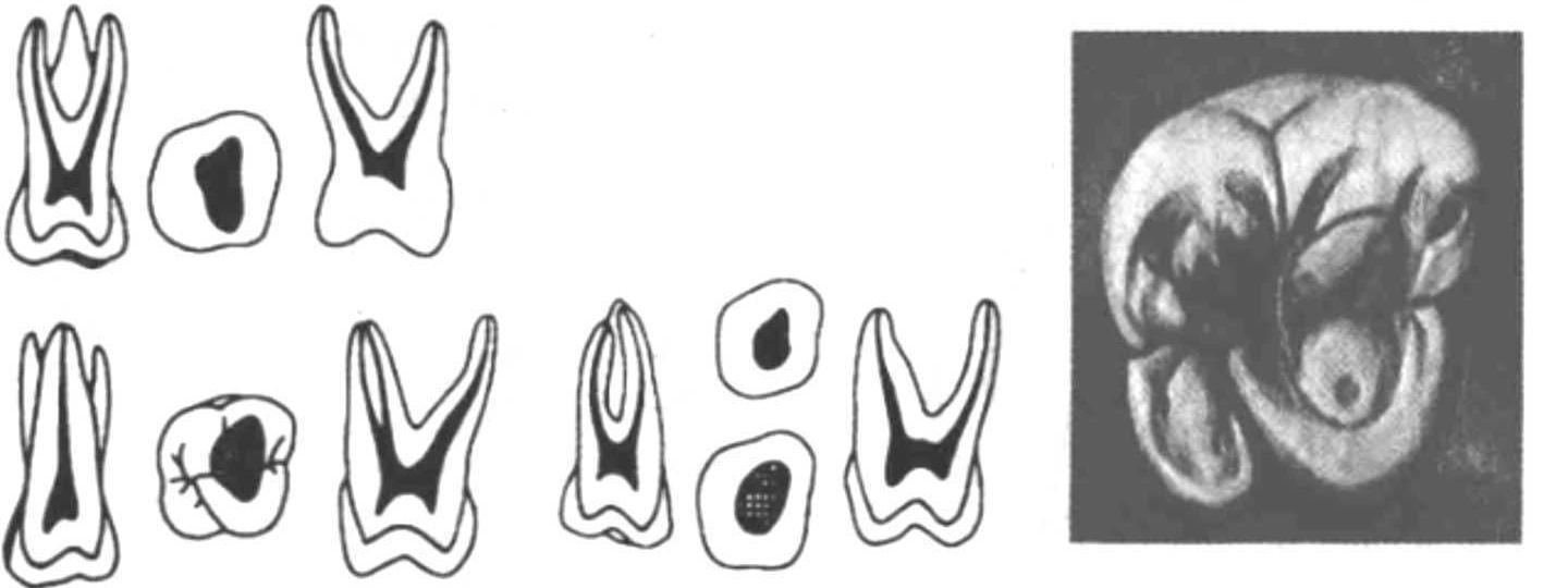 八、根管治療術(shù)